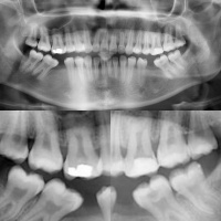 Taurodontismo en molares